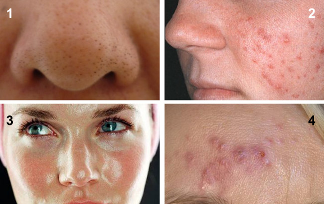 ADSS Profacial
