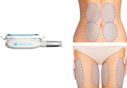 Charmstar Cryo plus 2